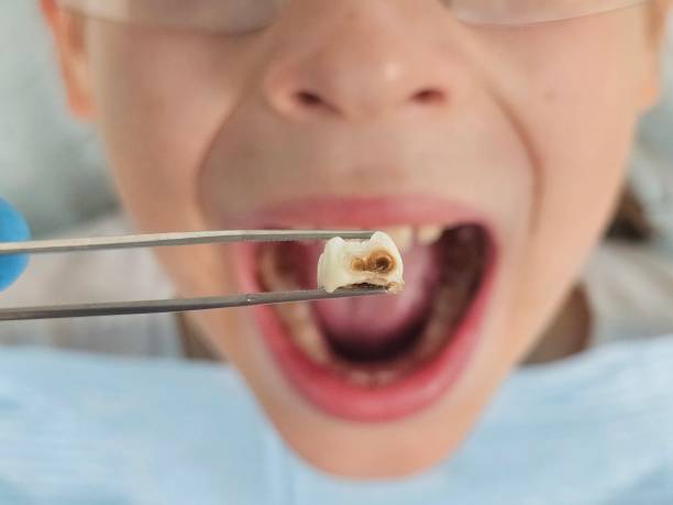 Best Emergency Broken Tooth Repair in Harb, OR